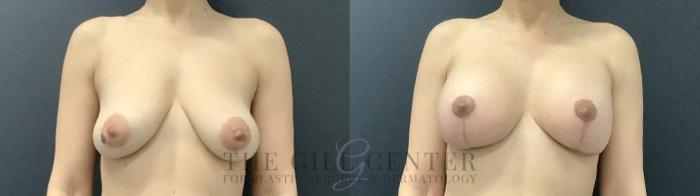 Breast Lift with Implants Case 707 Before & After Front | The Woodlands, TX | The Gill Center for Plastic Surgery and Dermatology