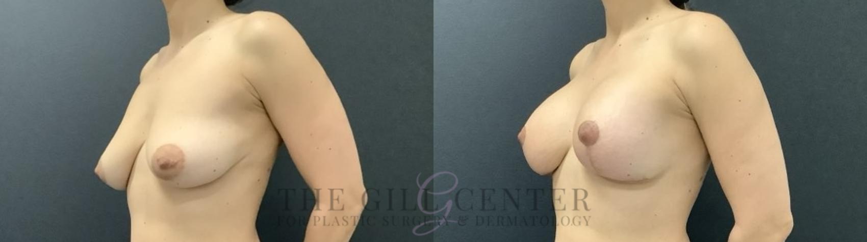 Breast Lift with Implants Case 707 Before & After Left Side | The Woodlands, TX | The Gill Center for Plastic Surgery and Dermatology