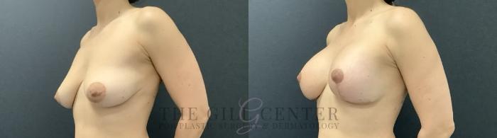Breast Lift with Implants Case 707 Before & After Left Side | The Woodlands, TX | The Gill Center for Plastic Surgery and Dermatology