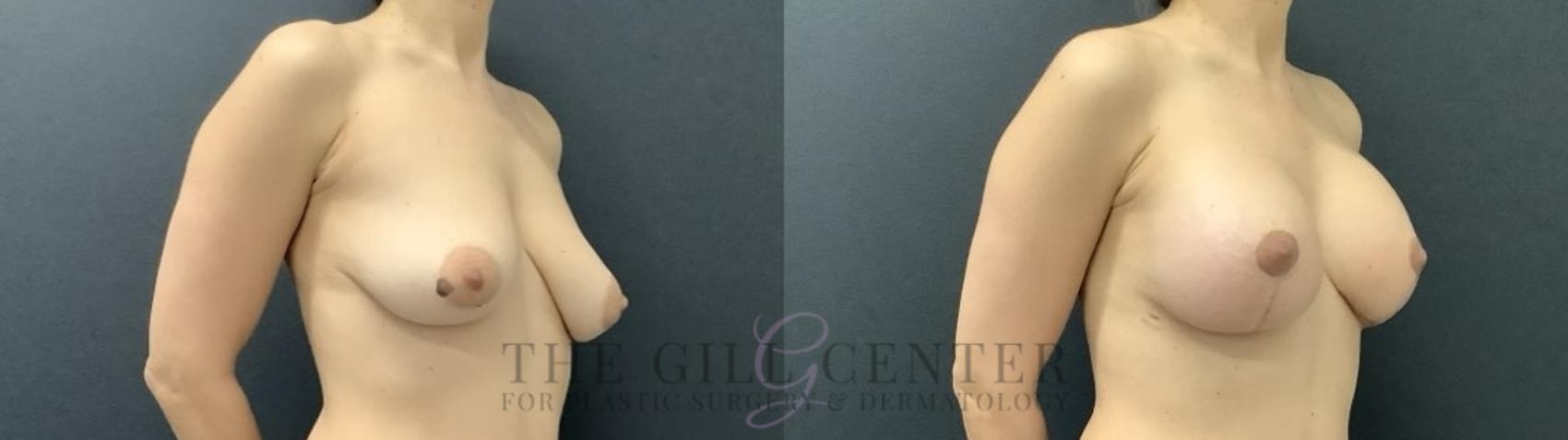 Breast Lift with Implants Case 707 Before & After Right Side | The Woodlands, TX | The Gill Center for Plastic Surgery and Dermatology
