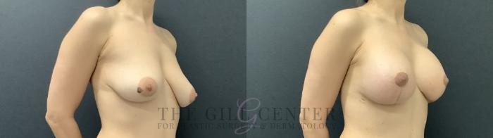 Breast Lift with Implants Case 707 Before & After Right Side | The Woodlands, TX | The Gill Center for Plastic Surgery and Dermatology