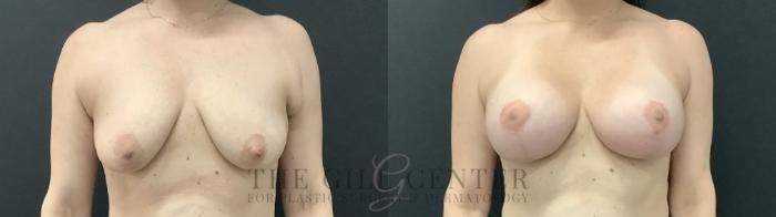 Breast Lift with Implants Case 708 Before & After Front | The Woodlands, TX | The Gill Center for Plastic Surgery and Dermatology