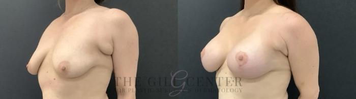 Breast Lift with Implants Case 708 Before & After Left Side | The Woodlands, TX | The Gill Center for Plastic Surgery and Dermatology