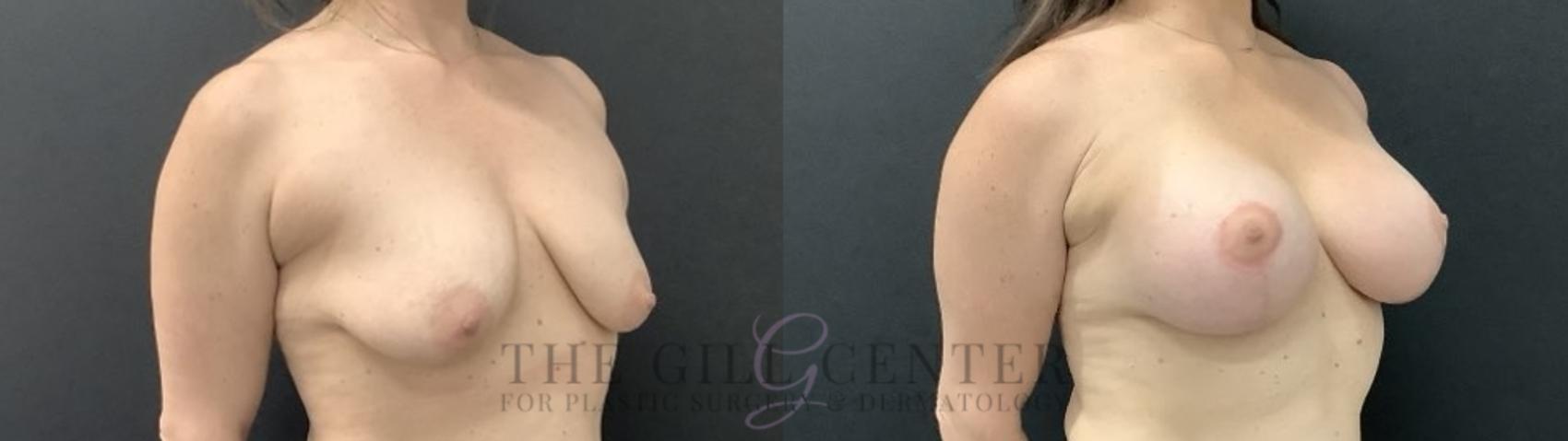 Breast Lift with Implants Case 708 Before & After Right Side | The Woodlands, TX | The Gill Center for Plastic Surgery and Dermatology