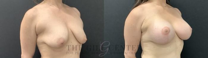 Breast Lift with Implants Case 708 Before & After Right Side | The Woodlands, TX | The Gill Center for Plastic Surgery and Dermatology