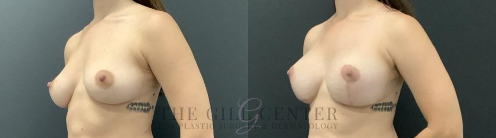 Breast Lift with Implants Case 710 Before & After Left Side | The Woodlands, TX | The Gill Center for Plastic Surgery and Dermatology