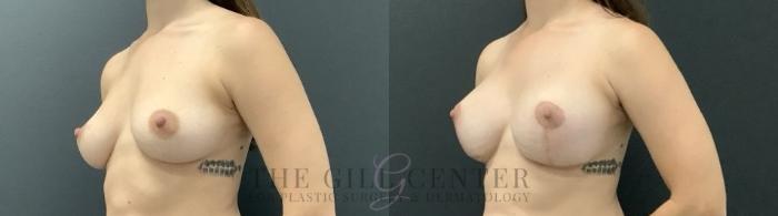 Breast Lift with Implants Case 710 Before & After Left Side | The Woodlands, TX | The Gill Center for Plastic Surgery and Dermatology