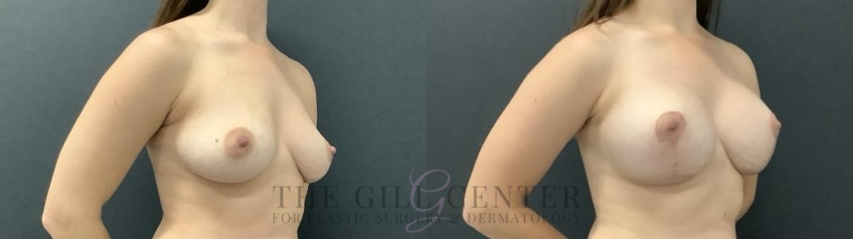 Breast Lift with Implants Case 710 Before & After Right Side | The Woodlands, TX | The Gill Center for Plastic Surgery and Dermatology