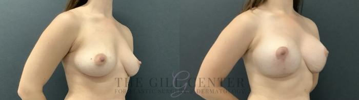 Breast Lift with Implants Case 710 Before & After Right Side | The Woodlands, TX | The Gill Center for Plastic Surgery and Dermatology