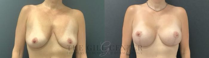 Breast Lift with Implants Case 711 Before & After Front | The Woodlands, TX | The Gill Center for Plastic Surgery and Dermatology