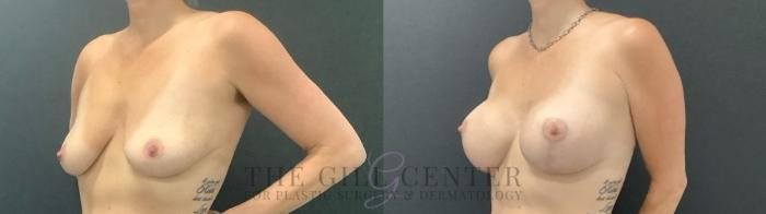 Breast Lift with Implants Case 711 Before & After Left Side | The Woodlands, TX | The Gill Center for Plastic Surgery and Dermatology