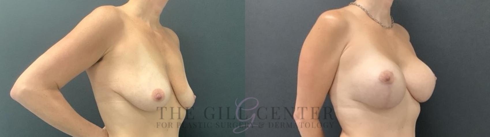 Breast Lift with Implants Case 711 Before & After Right Side | The Woodlands, TX | The Gill Center for Plastic Surgery and Dermatology