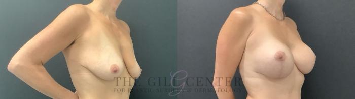 Breast Lift with Implants Case 711 Before & After Right Side | The Woodlands, TX | The Gill Center for Plastic Surgery and Dermatology