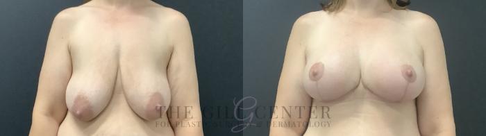 Breast Lift with Implants Case 714 Before & After Front | The Woodlands, TX | The Gill Center for Plastic Surgery and Dermatology