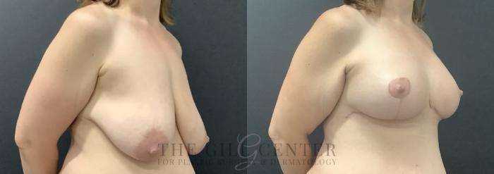 Breast Lift with Implants Case 714 Before & After Right Side | The Woodlands, TX | The Gill Center for Plastic Surgery and Dermatology