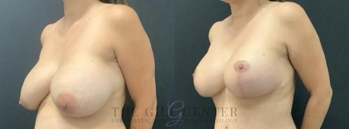 Breast Lift with Implants Case 716 Before & After Left Oblique | The Woodlands, TX | The Gill Center for Plastic Surgery and Dermatology