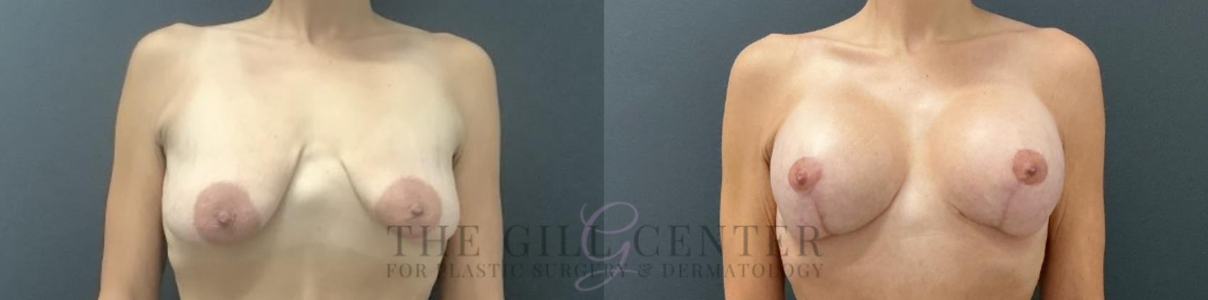 Breast Lift with Implants Case 724 Before & After Front | The Woodlands, TX | The Gill Center for Plastic Surgery and Dermatology