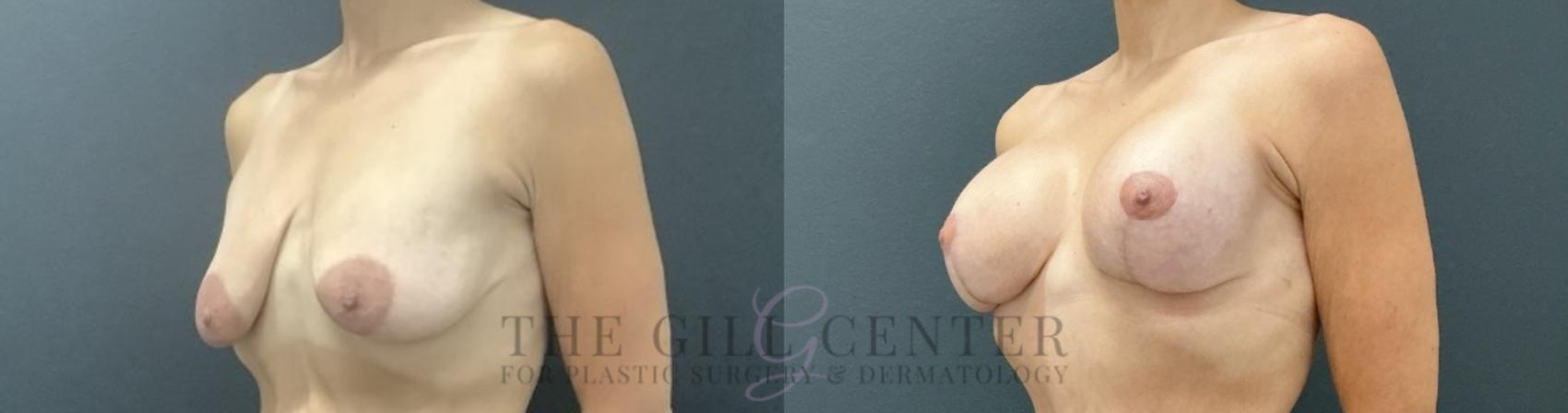 Breast Lift with Implants Case 724 Before & After Left Oblique | The Woodlands, TX | The Gill Center for Plastic Surgery and Dermatology