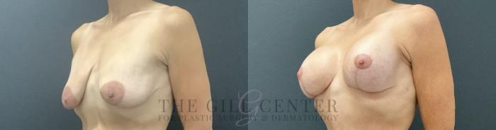 Breast Lift with Implants Case 724 Before & After Left Oblique | The Woodlands, TX | The Gill Center for Plastic Surgery and Dermatology