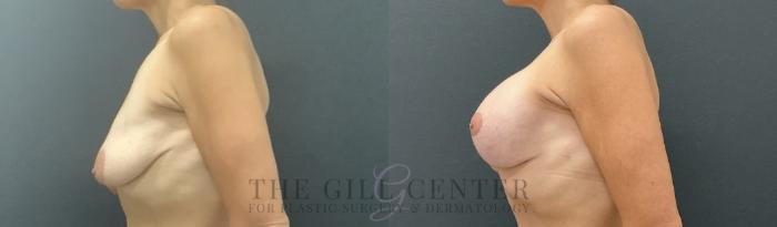 Breast Lift with Implants Case 724 Before & After Left Side | The Woodlands, TX | The Gill Center for Plastic Surgery and Dermatology