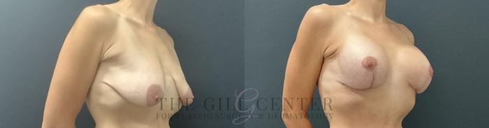 Breast Lift with Implants Case 724 Before & After Right Oblique | The Woodlands, TX | The Gill Center for Plastic Surgery and Dermatology