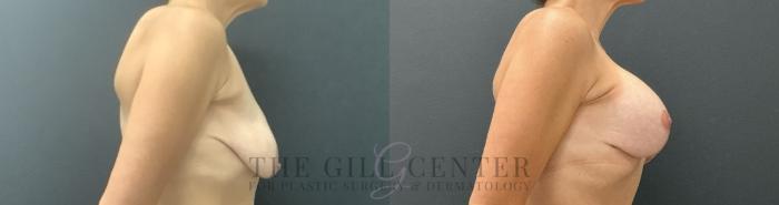 Breast Lift with Implants Case 724 Before & After Right Side | The Woodlands, TX | The Gill Center for Plastic Surgery and Dermatology