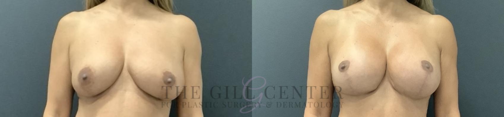 Breast Lift with Implants Case 728 Before & After Front | The Woodlands, TX | The Gill Center for Plastic Surgery and Dermatology
