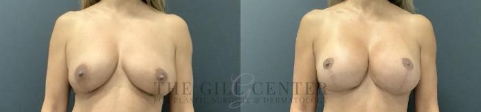 Breast Lift with Implants Case 728 Before & After Front | The Woodlands, TX | The Gill Center for Plastic Surgery and Dermatology