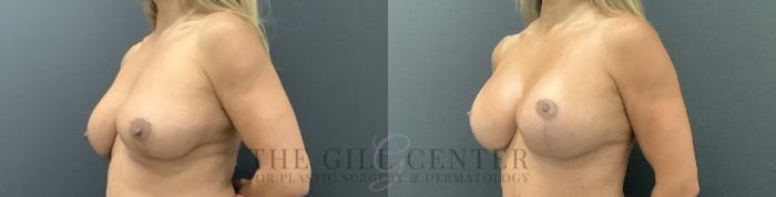 Breast Lift with Implants Case 728 Before & After Left Oblique | The Woodlands, TX | The Gill Center for Plastic Surgery and Dermatology