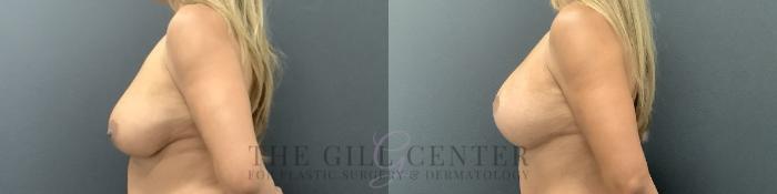 Breast Lift with Implants Case 728 Before & After Left Side | The Woodlands, TX | The Gill Center for Plastic Surgery and Dermatology