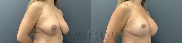 Breast Lift with Implants Case 728 Before & After Right Oblique | The Woodlands, TX | The Gill Center for Plastic Surgery and Dermatology