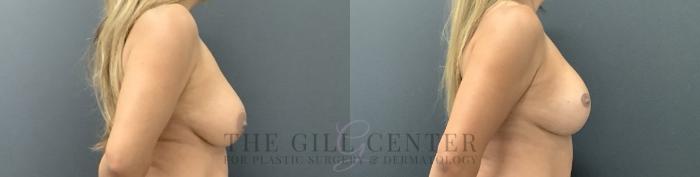 Breast Lift with Implants Case 728 Before & After Right Side | The Woodlands, TX | The Gill Center for Plastic Surgery and Dermatology