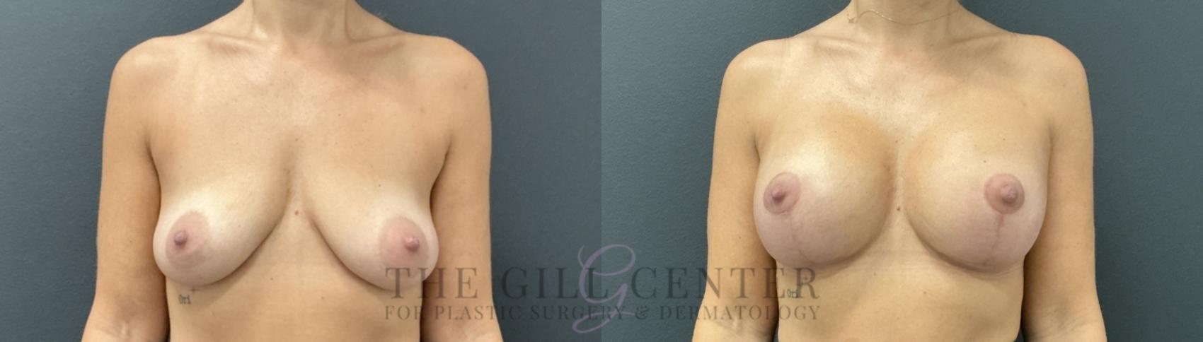 Breast Lift with Implants Case 732 Before & After Front | The Woodlands, TX | The Gill Center for Plastic Surgery and Dermatology