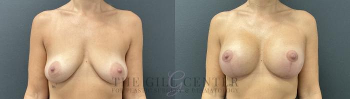 Breast Lift with Implants Case 732 Before & After Front | The Woodlands, TX | The Gill Center for Plastic Surgery and Dermatology