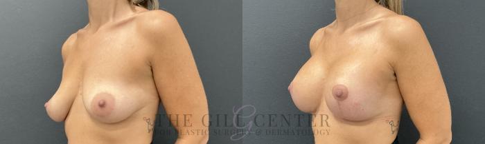 Breast Lift with Implants Case 732 Before & After Left Oblique | The Woodlands, TX | The Gill Center for Plastic Surgery and Dermatology