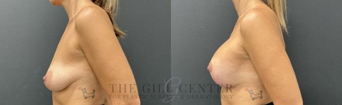 Breast Lift with Implants Case 732 Before & After Left Side | The Woodlands, TX | The Gill Center for Plastic Surgery and Dermatology