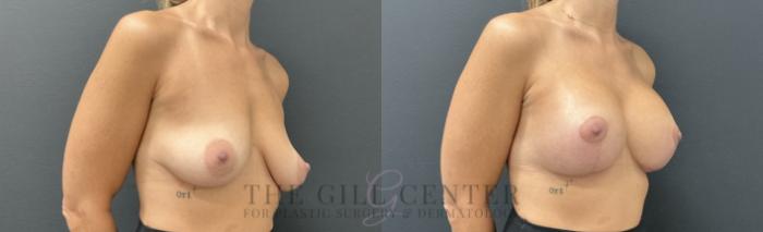 Breast Lift with Implants Case 732 Before & After Right Oblique | The Woodlands, TX | The Gill Center for Plastic Surgery and Dermatology