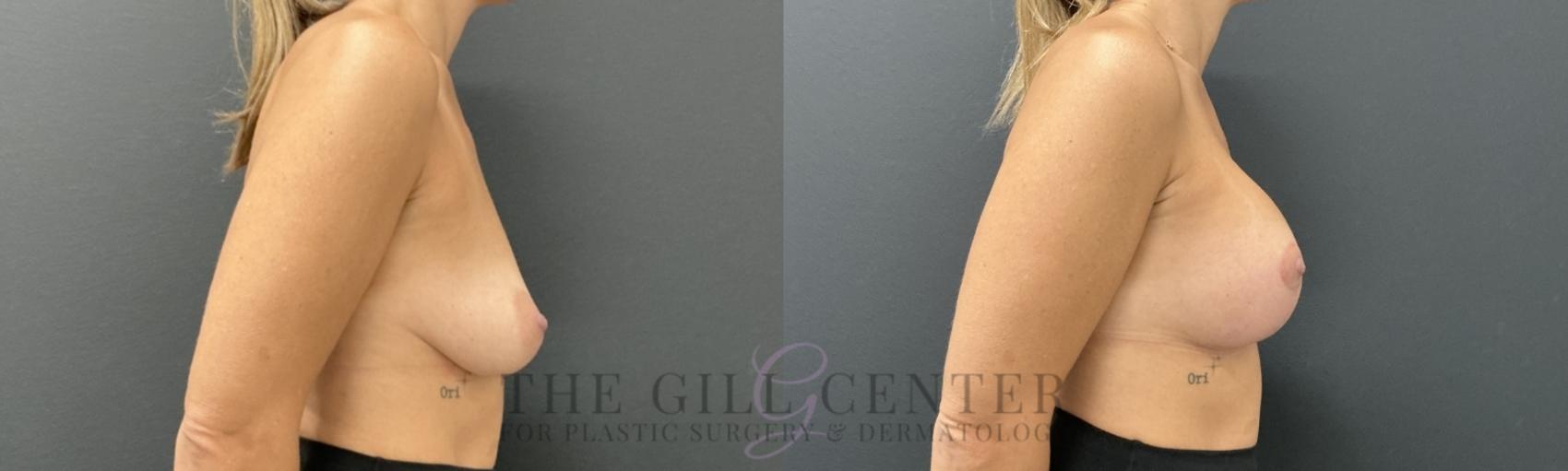 Breast Lift with Implants Case 732 Before & After Right Side | The Woodlands, TX | The Gill Center for Plastic Surgery and Dermatology