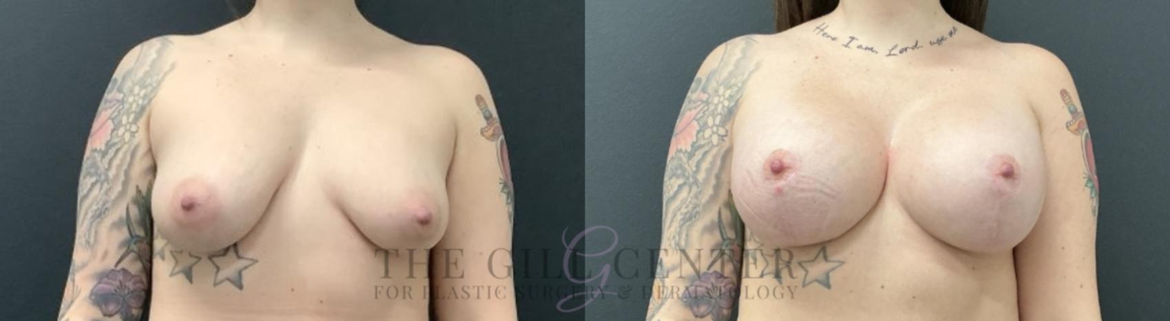 Breast Lift with Implants Case 735 Before & After Front | The Woodlands, TX | The Gill Center for Plastic Surgery and Dermatology