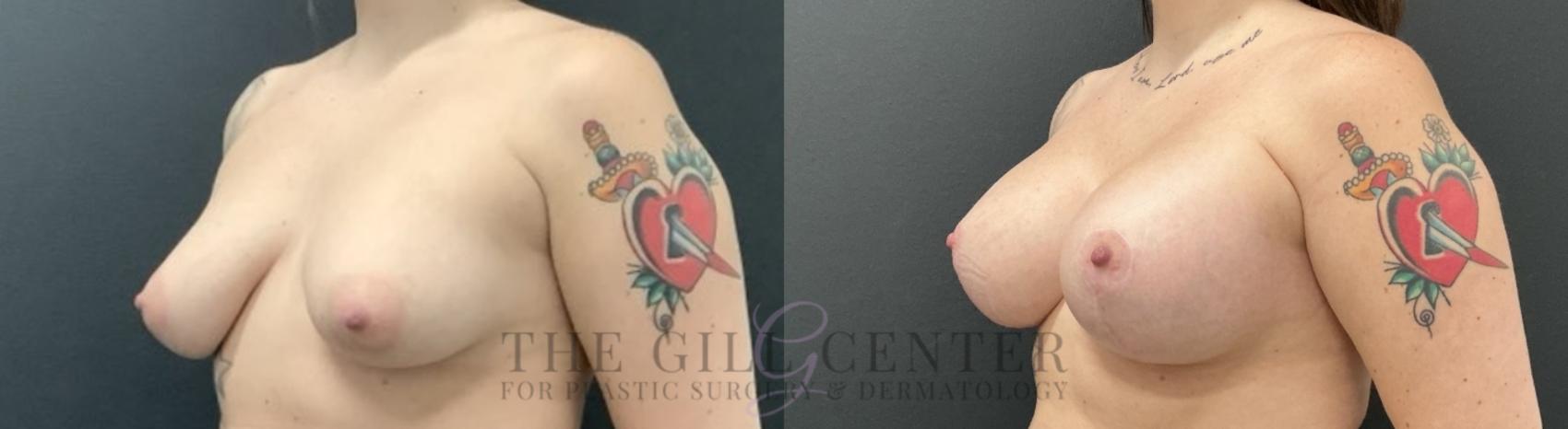 Breast Lift with Implants Case 735 Before & After Left Oblique | The Woodlands, TX | The Gill Center for Plastic Surgery and Dermatology