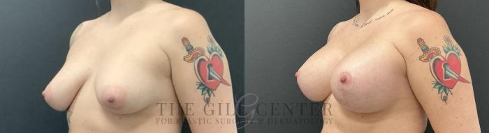 Breast Lift with Implants Case 735 Before & After Left Oblique | The Woodlands, TX | The Gill Center for Plastic Surgery and Dermatology