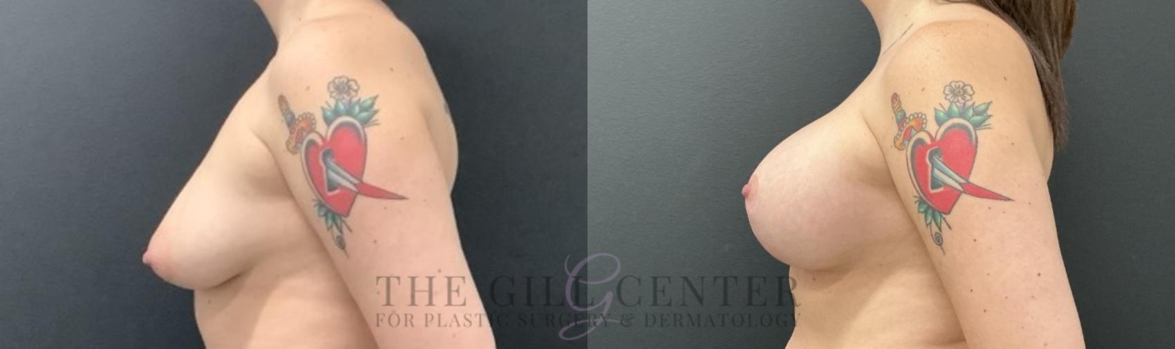 Breast Lift with Implants Case 735 Before & After Left Side | The Woodlands, TX | The Gill Center for Plastic Surgery and Dermatology