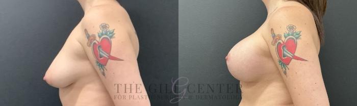 Breast Lift with Implants Case 735 Before & After Left Side | The Woodlands, TX | The Gill Center for Plastic Surgery and Dermatology