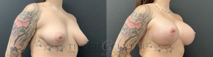 Breast Lift with Implants Case 735 Before & After Right Oblique | The Woodlands, TX | The Gill Center for Plastic Surgery and Dermatology
