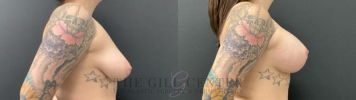 Breast Lift with Implants Case 735 Before & After Right Side | The Woodlands, TX | The Gill Center for Plastic Surgery and Dermatology