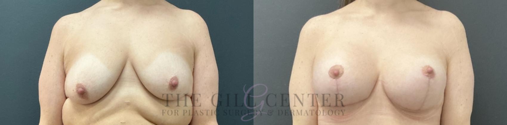 Breast Lift with Implants Case 739 Before & After Front | The Woodlands, TX | The Gill Center for Plastic Surgery and Dermatology