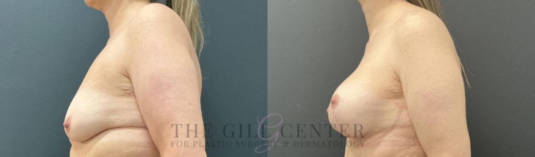 Breast Lift with Implants Case 739 Before & After Left Side | The Woodlands, TX | The Gill Center for Plastic Surgery and Dermatology
