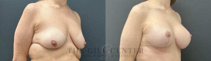Breast Lift with Implants Case 739 Before & After Right Oblique | The Woodlands, TX | The Gill Center for Plastic Surgery and Dermatology