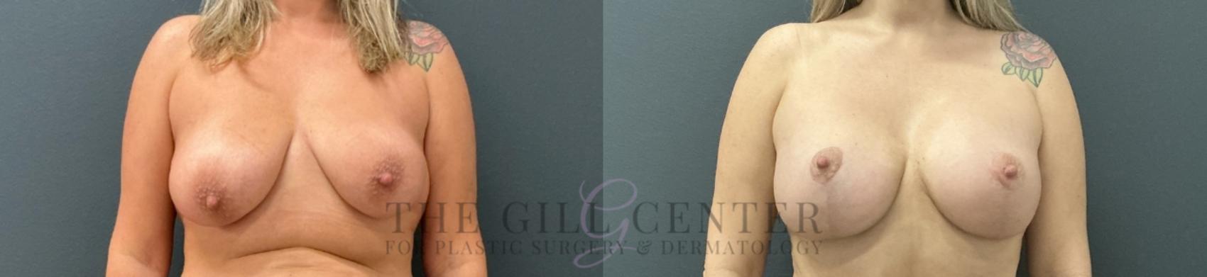 Breast Lift with Implants Case 753 Before & After Front | The Woodlands, TX | The Gill Center for Plastic Surgery and Dermatology