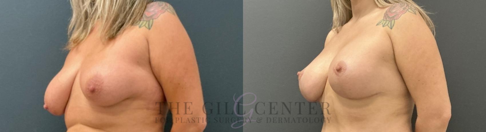 Breast Lift with Implants Case 753 Before & After Left Oblique | The Woodlands, TX | The Gill Center for Plastic Surgery and Dermatology